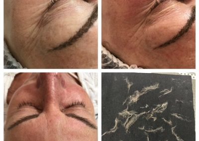 Dermaplanning: before and after. Dermaplanning removes the top dead layer of skin cells along with the fine vellus hair on the face and neck.