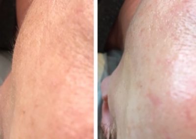 Dermaplanning: before and after. Dermaplanning removes the top dead layer of skin cells along with the fine vellus hair on the face and neck.