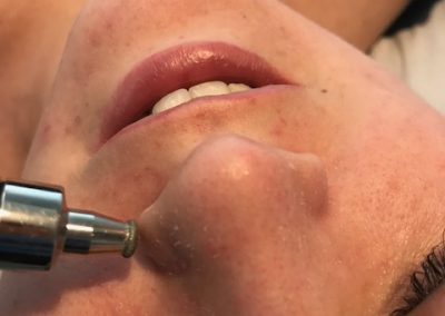 A lady during Diamond dermabrasion, she has her eyes closed but seems comfortable, her skin has lost the dull texture and looks rejuvenated.