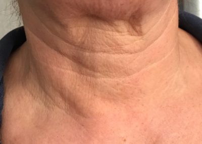 A non surgical neck lift before photo. Her neck has wrinkles and is slightly saggy, as happens to us all with age.