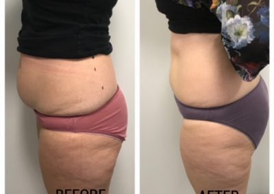 A lady. In the picture on the left he has a build up of fatty tissues on her abdomen. On the right an after photo with a significant difference.