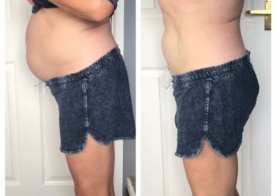 A man in blue shorts. In the picture on the left he has a build up of fatty tissues on his abdomen. On the right an after photo with a significant difference.