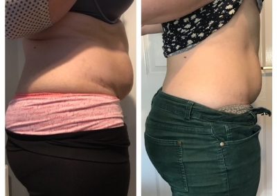 A lady. In the picture on the left he has a build up of fatty tissues on her abdomen. On the right an after photo with a significant difference.