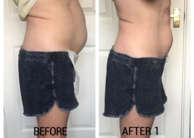 A lady in blue shorts. In the picture on the left he has a build up of fatty tissues on her abdomen. On the right an after photo with a significant difference.