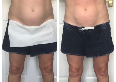 A lady in blue shorts. In the picture on the left he has a build up of fatty tissues on her abdomen. On the right an after photo with a significant difference.