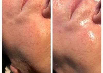 Dermabrasion before and after. photo 1 is of a lady, her skin is quite dull looking. Photo two is after dermabrasion her skin has lost the dull texture and looks rejuvenated.