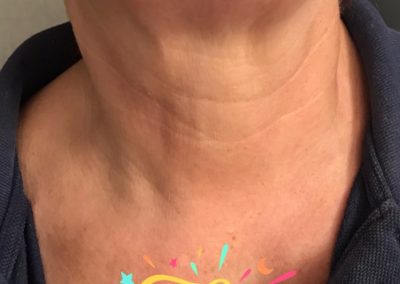 A non surgical neck lift after phot. Her neck looks much tighter with a significant difference to the before photo.